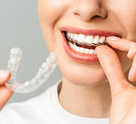 Invisalign (nouvelle technologie)