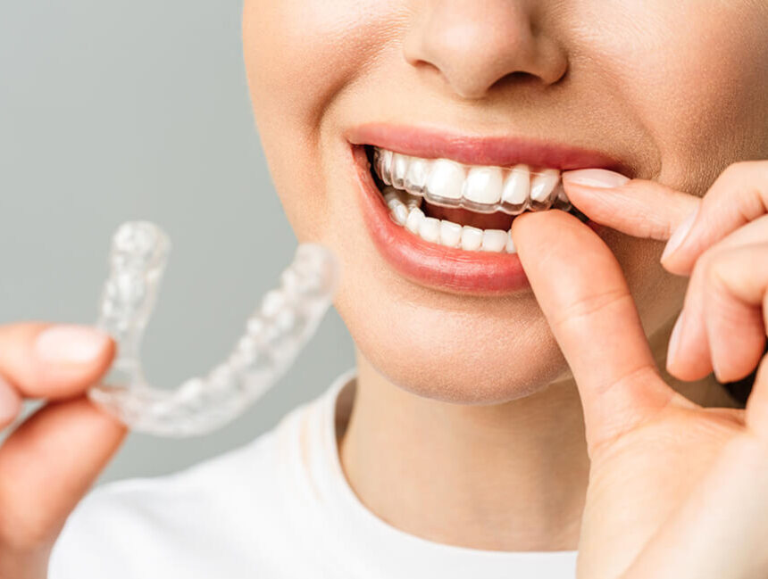 Invisalign (nouvelle technologie)