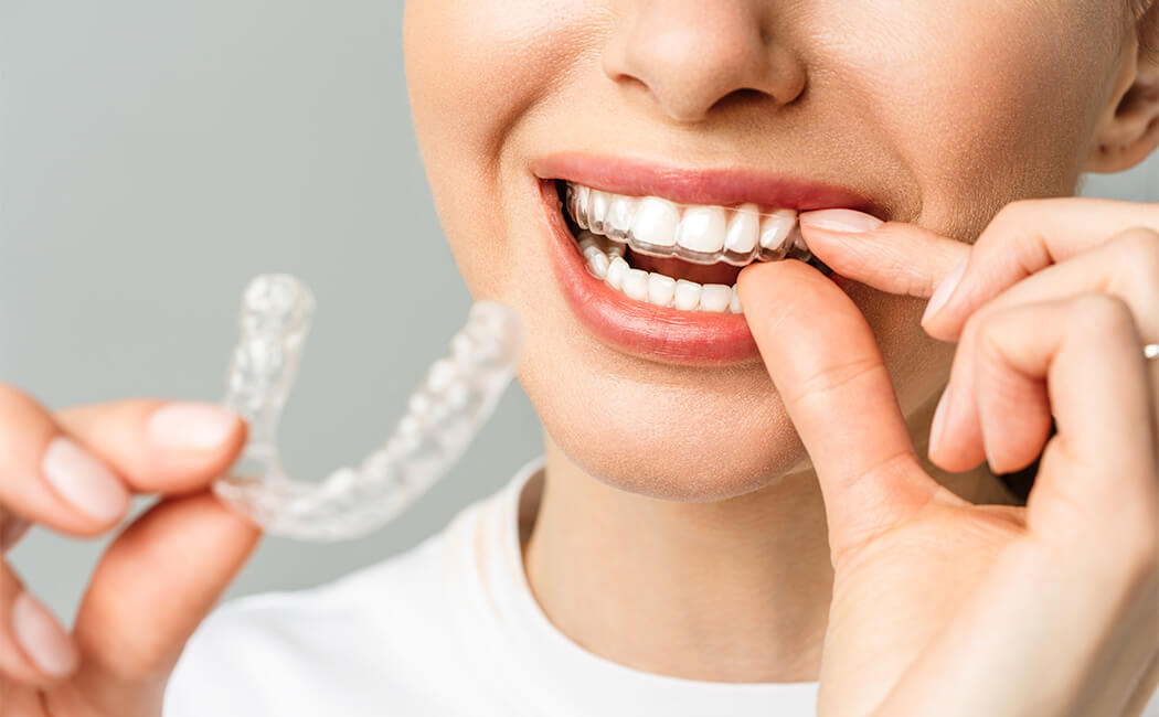 Invisalign (nouvelle technologie)